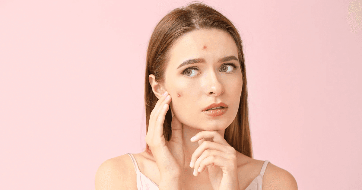 Acne Program All-in-1: Laser, Facial, Peel + Gluta Drip
