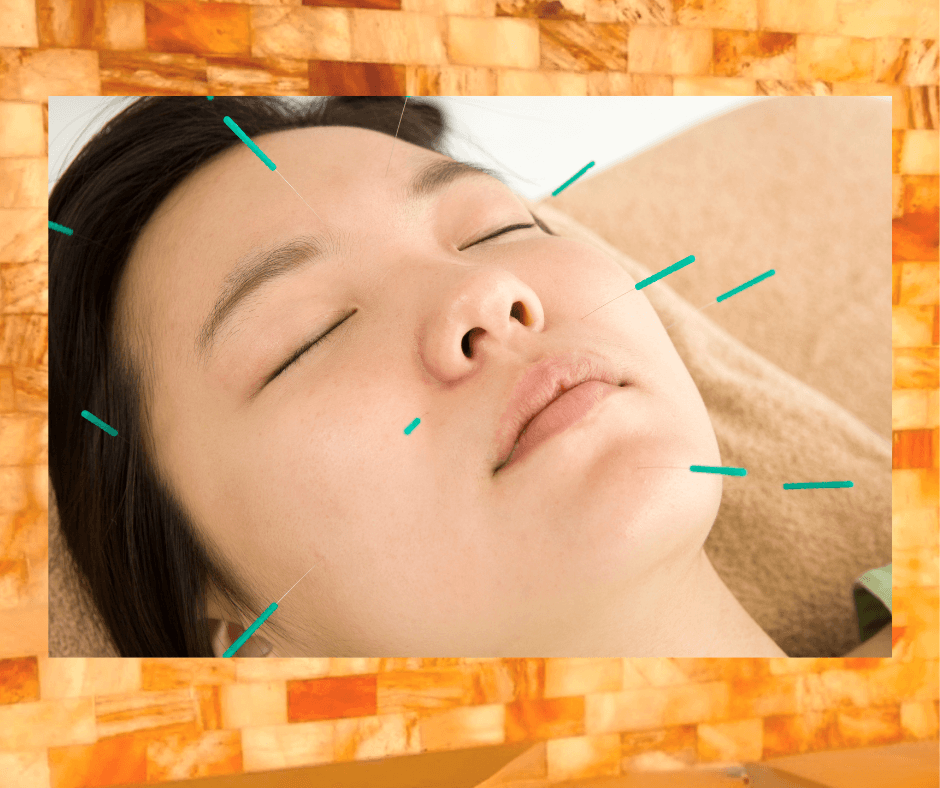 Cosmetic Acupuncture Aculift, Natural Anti-Aging