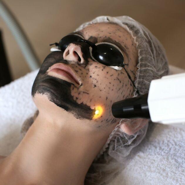 Carbon Laser Black Doll Facial, 4 Sessions