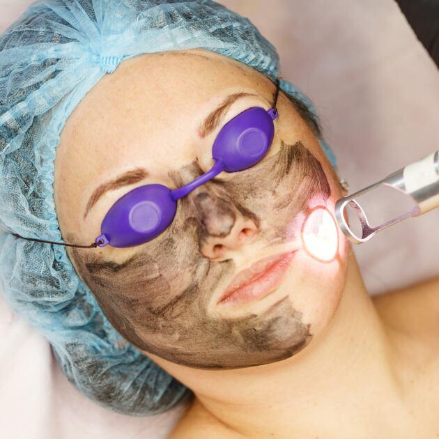 Black Doll Carbon Laser Facial, Dark Spot Fade