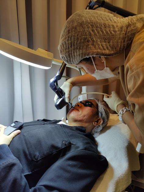 CO2 Pixel Laser Resurfacing for Acne Scars - Full