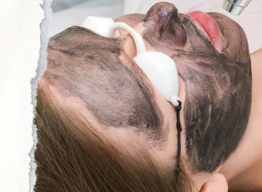 Hollywood Carbon Laser Peel for Youthful Glow