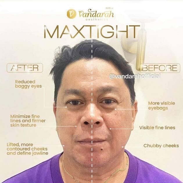 Maxtight + Lipo Contour Face Lifting & Tightening Duo