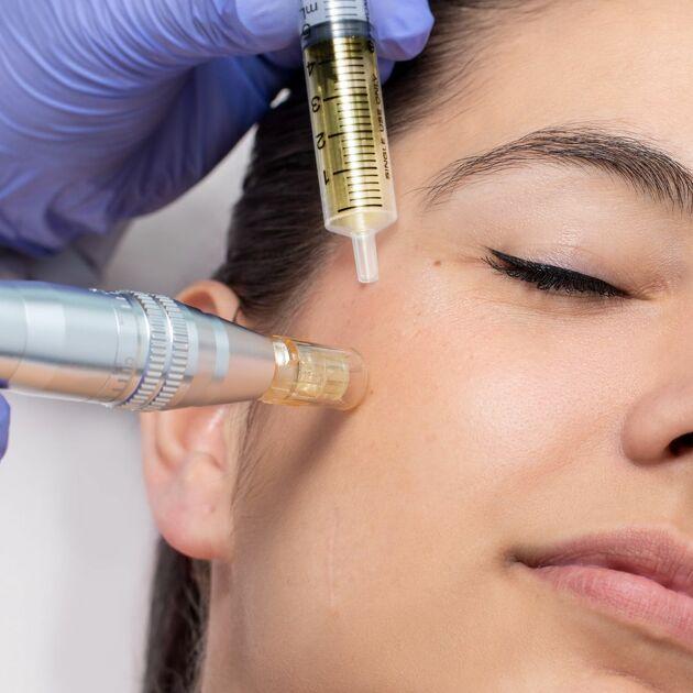 PRP Vampire Facial, Microneedling Rejuvenation