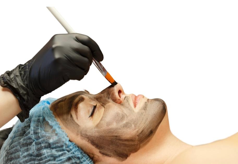 Carbon Laser Facial, No Downtime - 2 Sessions