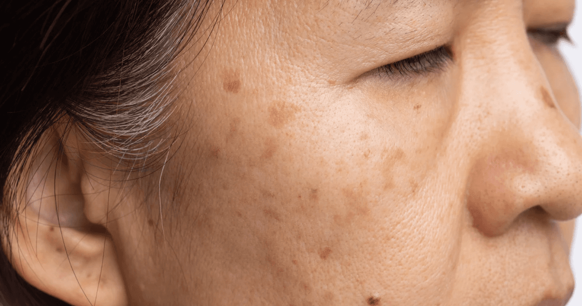 Melasma Lite Program: 6 Sessions of Laser + Injection