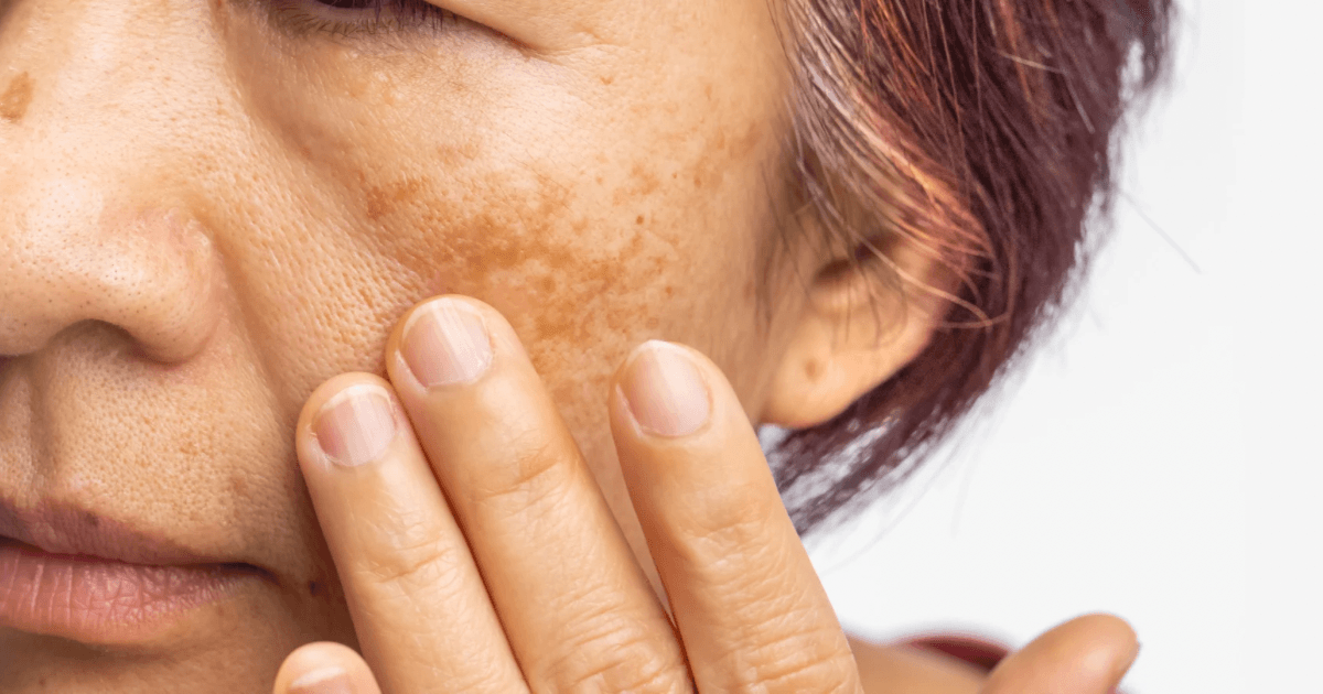 Melasma Ultimate Program: 8 Sessions + FREE Gluta Drip