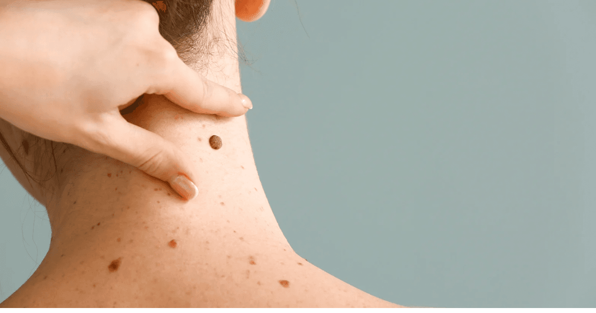 Mole + Skin Tag Removal: Non-Surgical Laser