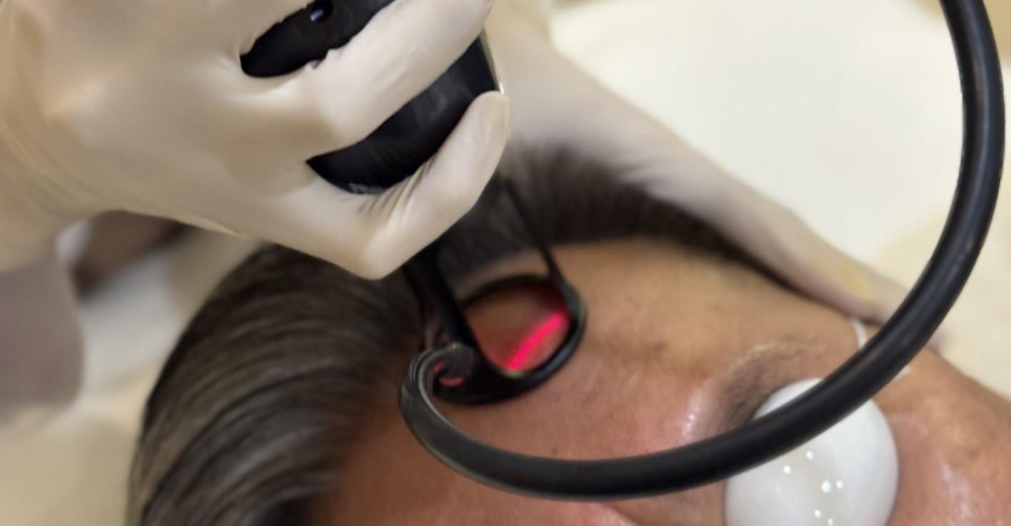 Rejuran S Scar Booster + Subcision for Pitted Scars