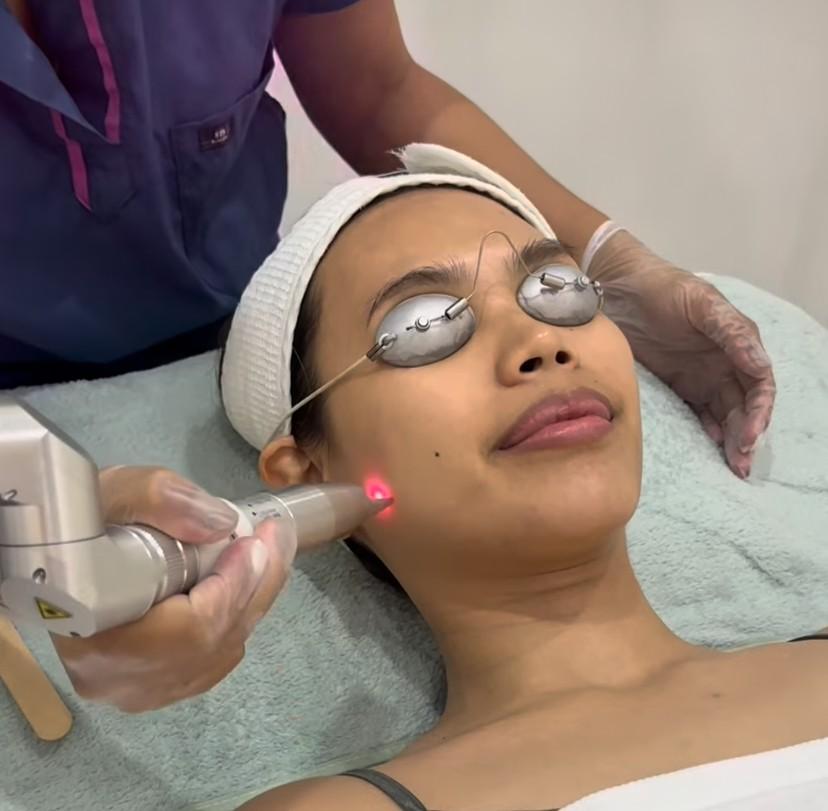 Revlite Face & Neck Whitening Laser, 3 Sessions