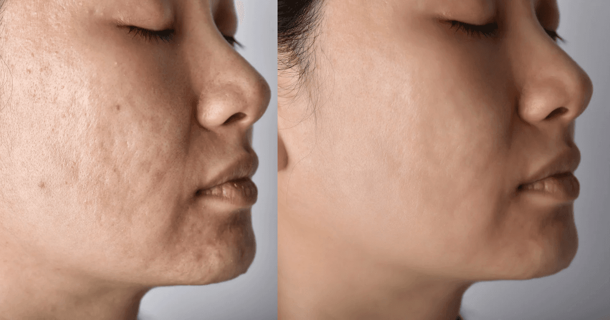 Scar Removal Program: 2-Month Non-Surgical Resurfacing