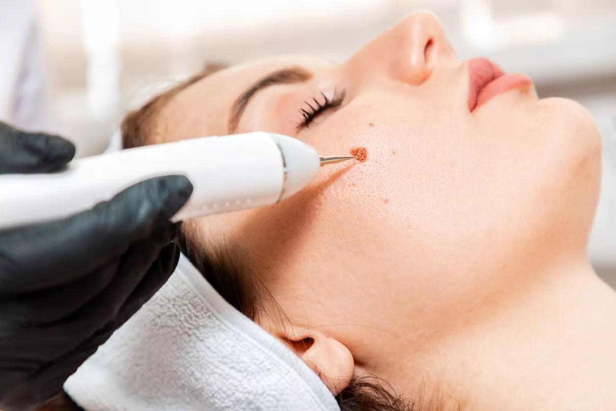 Warts Removal, Unlimited per Area in One Session