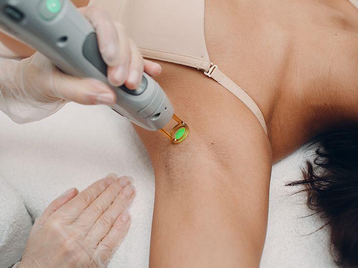Underarm Laser Hair Removal, 5 Sessions