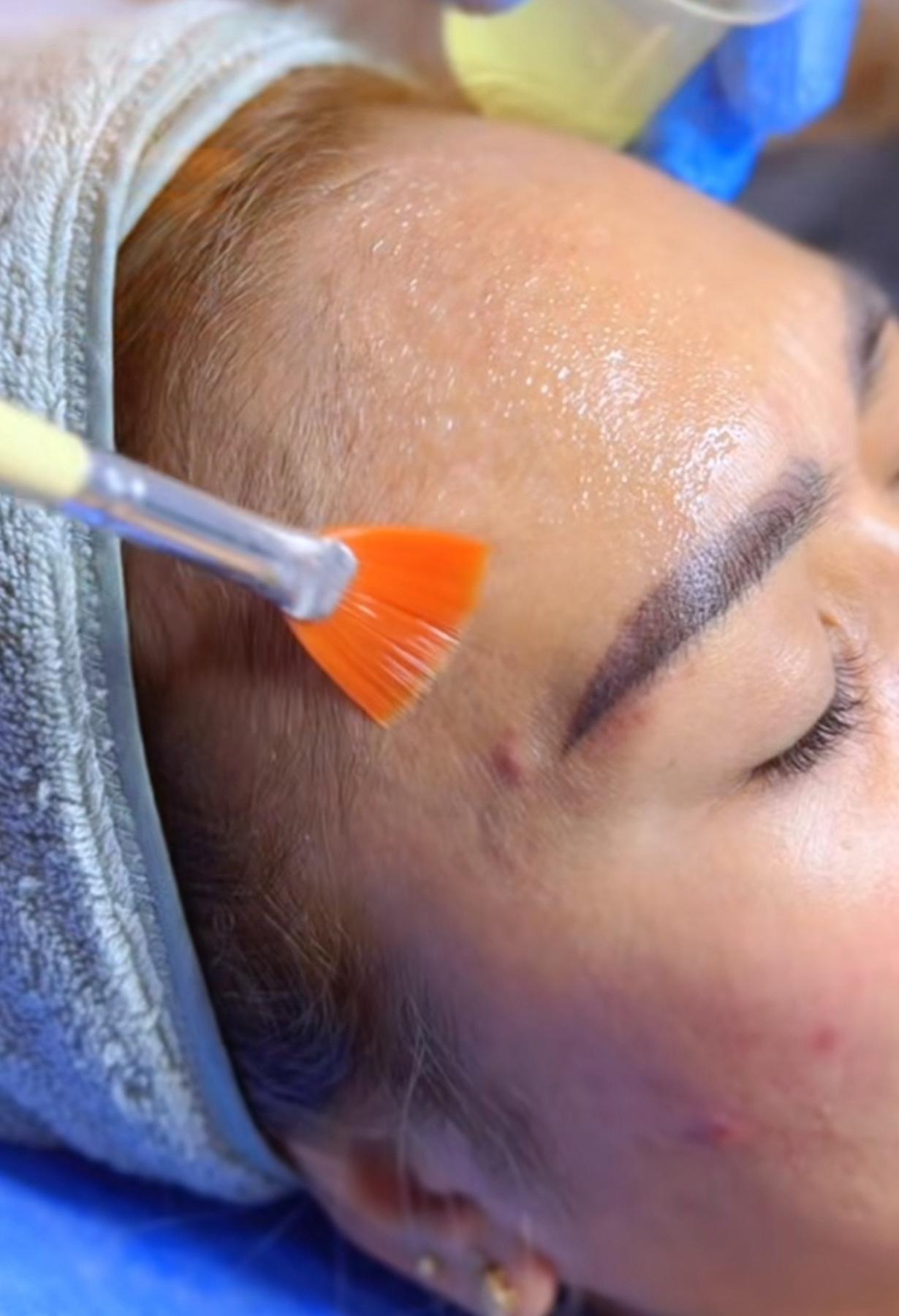 TCA Chemical Peel: Resurface Scars & Pigmentation