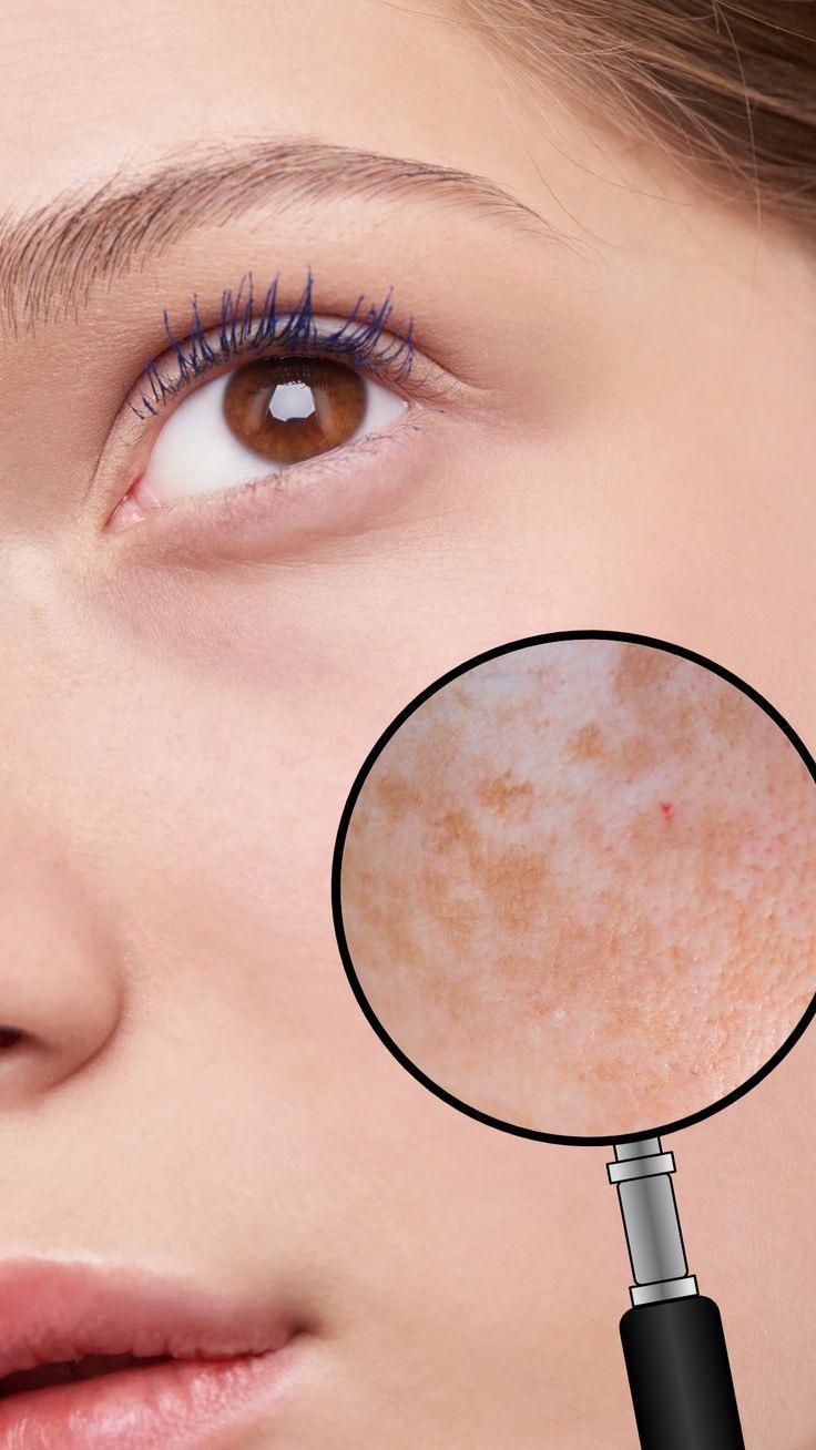 Melasma Removal: Unlimited Any Area for 3 Months