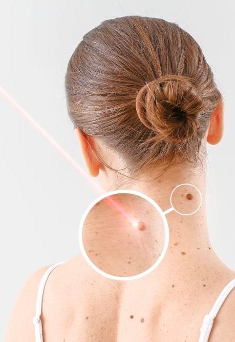 Warts Removal: Unlimited Whole Body for 3 Months