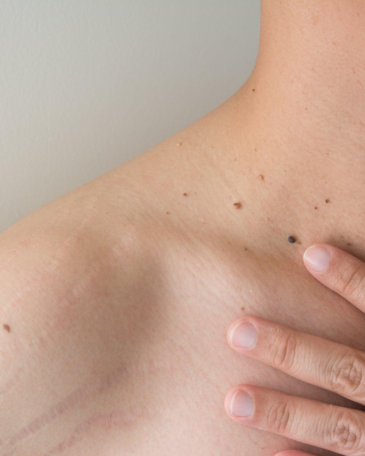 Warts Removal for Face & Neck, Electrocautery