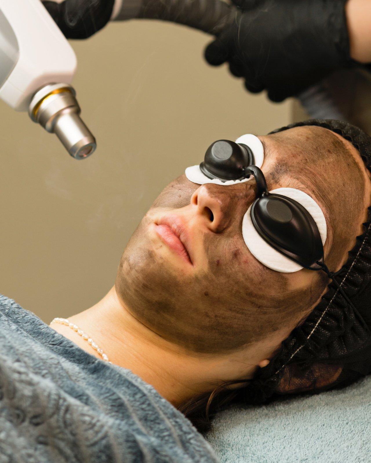 Carbon Peel Laser Facial for Oily, Congested Skin